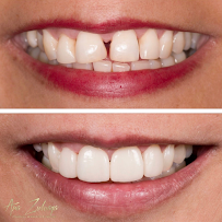 Dra. Ana Zuluaga - Diseño de Sonrisa en Medellín