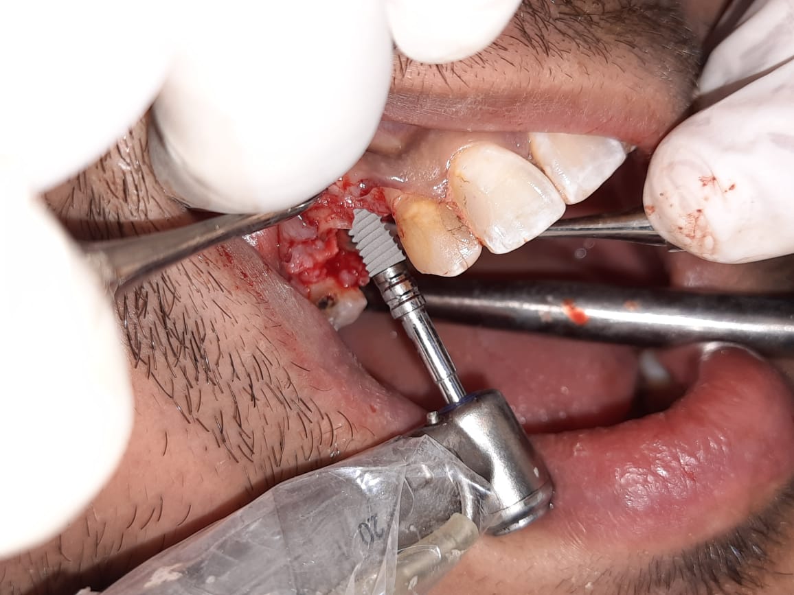 Delhi Dental Implant Center