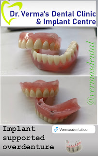 Dr. Verma's Dental Clinic & Implant Centre - Vikaspuri | Dental Implant specialist in Vikaspuri, New Delhi