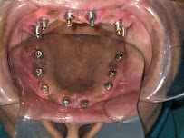 Dr Popli's Dental Clinic And Implant Centre