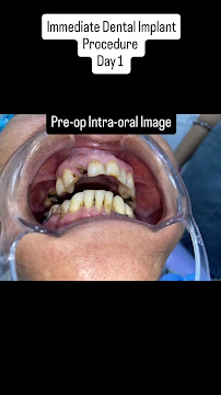 DR ROHIT YADAV IMPLANT SURGEON FACIAL TRAUMA SURGEON DWARKA