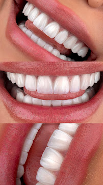 Smile Dental Center Medellín | Carillas Dentales y Diseño de Sonrisa