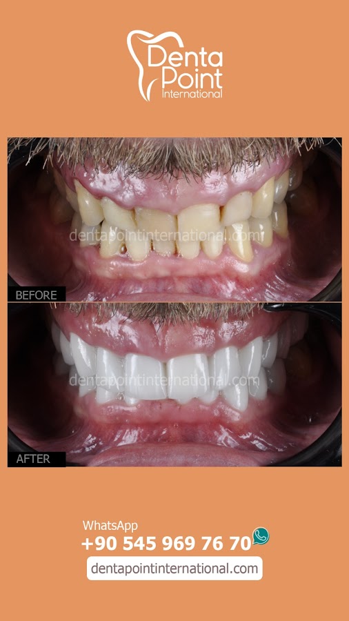 Zel Dentapoint Di Poliklinii Karyaka Ubesi Zirkonyum Di Mplant Estetik Di Tedavileri Ortodonti dental clinic in Izmir
