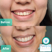 Plus Dental Clinic & Implant Center - Single Visit Root Canal, Teeth Cleaning, Dental Implants, Dental Veneer, Tooth Implant