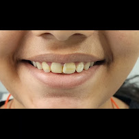Plus Dental Clinic & Implant Center - Single Visit Root Canal, Teeth Cleaning, Dental Implants, Dental Veneer, Tooth Implant