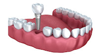 Aledentz Dental & Medical Center Delhi NCR