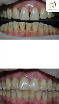 The Dental Hub – Dental Clinic in Gurgaon | Invisalign | Dental Implants & Root Canal Treatment In Gurgaon