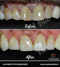 The Dental Hub – Dental Clinic in Gurgaon | Invisalign | Dental Implants & Root Canal Treatment In Gurgaon