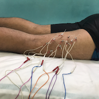 Acupuncture & Hijama cupping therapy | Acupuncture & Cupping clinic Saket Delhi