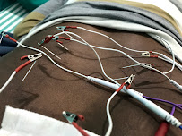Acupuncture & Hijama cupping therapy | Acupuncture & Cupping clinic Saket Delhi