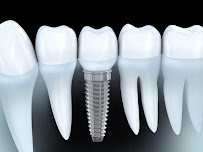 Dental Implants Saket