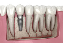 Dental Implants Saket