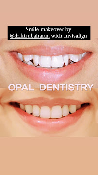 Opal dentistry