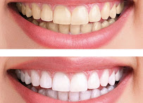 TEATREE Dental Clinic - AECS Layout, Singasandra, Bangalore.