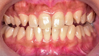 Teethling Dental Care | Root Canal Treatment in BTM Layout | Teeth Whitening & Straightening in BTM Layout