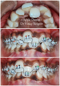 Apple Dental Clinic (#DrVinaySirigere) - Orthodontics | Oral Implants | Oral Rehabilitation | TMJ Spcialist | RootCanalTx |
