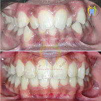 S.R. FAMILY DENTAL CLINIC - BEST IMPLANT CLINIC IN CHENNAI | BEST DENTAL ALIGNERS IN CHENNAI