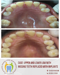 S.R. FAMILY DENTAL CLINIC - BEST IMPLANT CLINIC IN CHENNAI | BEST DENTAL ALIGNERS IN CHENNAI