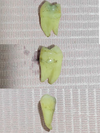 Ezhil Dental Studio| Dental Clinic in Velachery | Root Canal Treatment