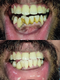 Ezhil Dental Studio| Dental Clinic in Velachery | Root Canal Treatment