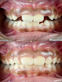 BOND DENTISTRY | Dr. Bejoy Zachariah
