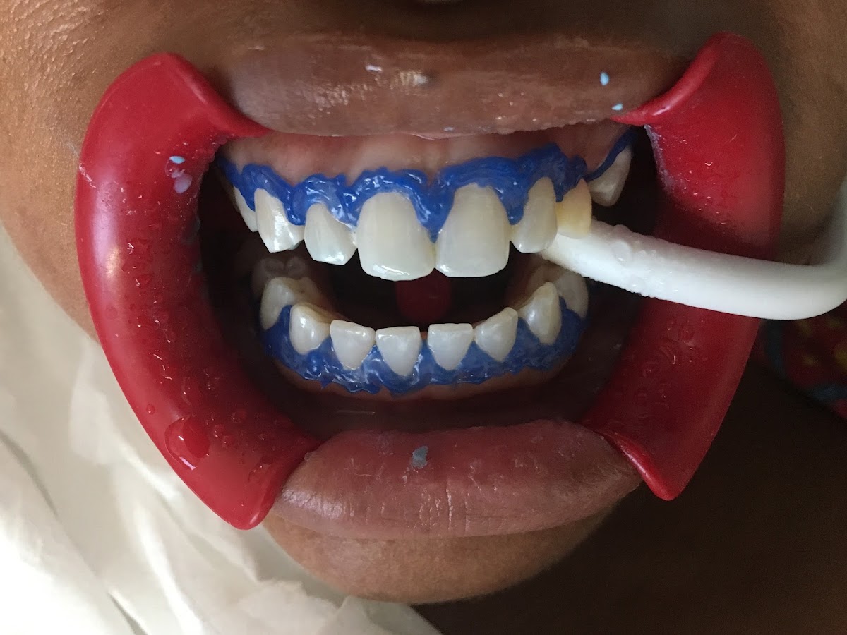 Dental OLA