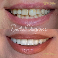 Dental Elegance