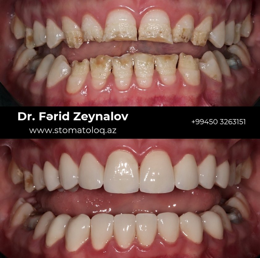 Zirconia crown
