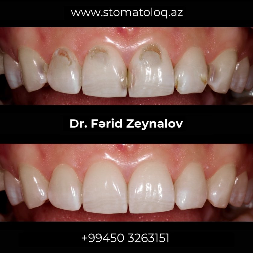 Cosmetic filling for anterior teeth