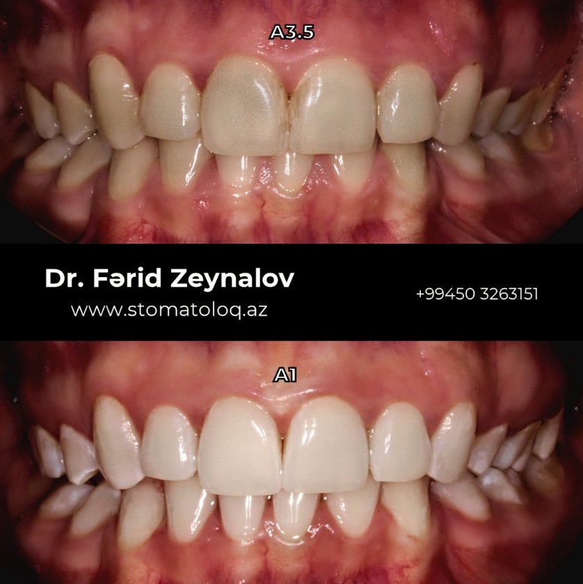 Teeth whitening (bleaching)