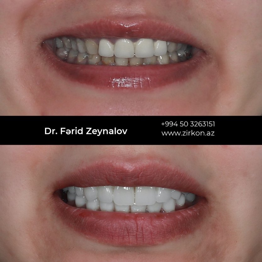 Zirconia crown