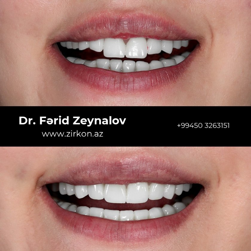Zirconia crown