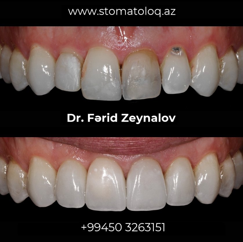 Zirconia crown