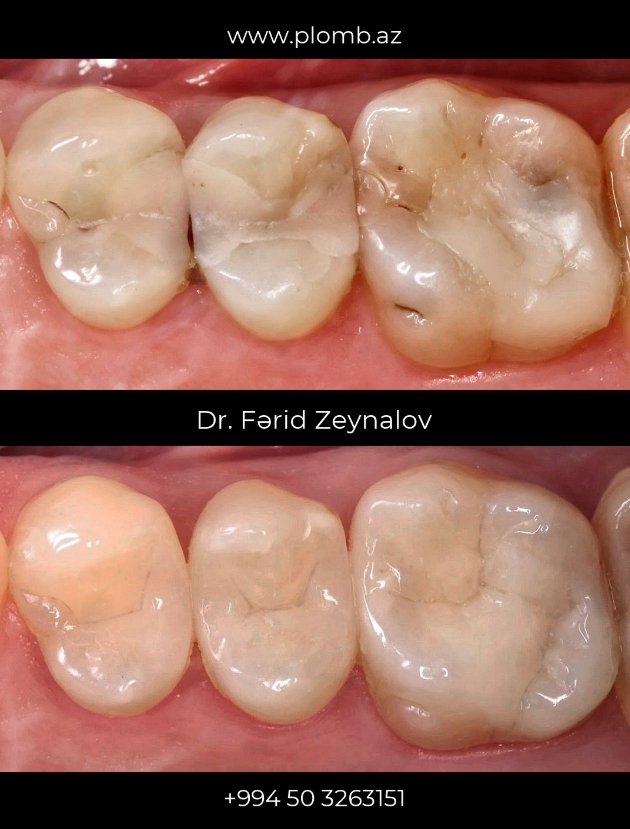 Dental fillin