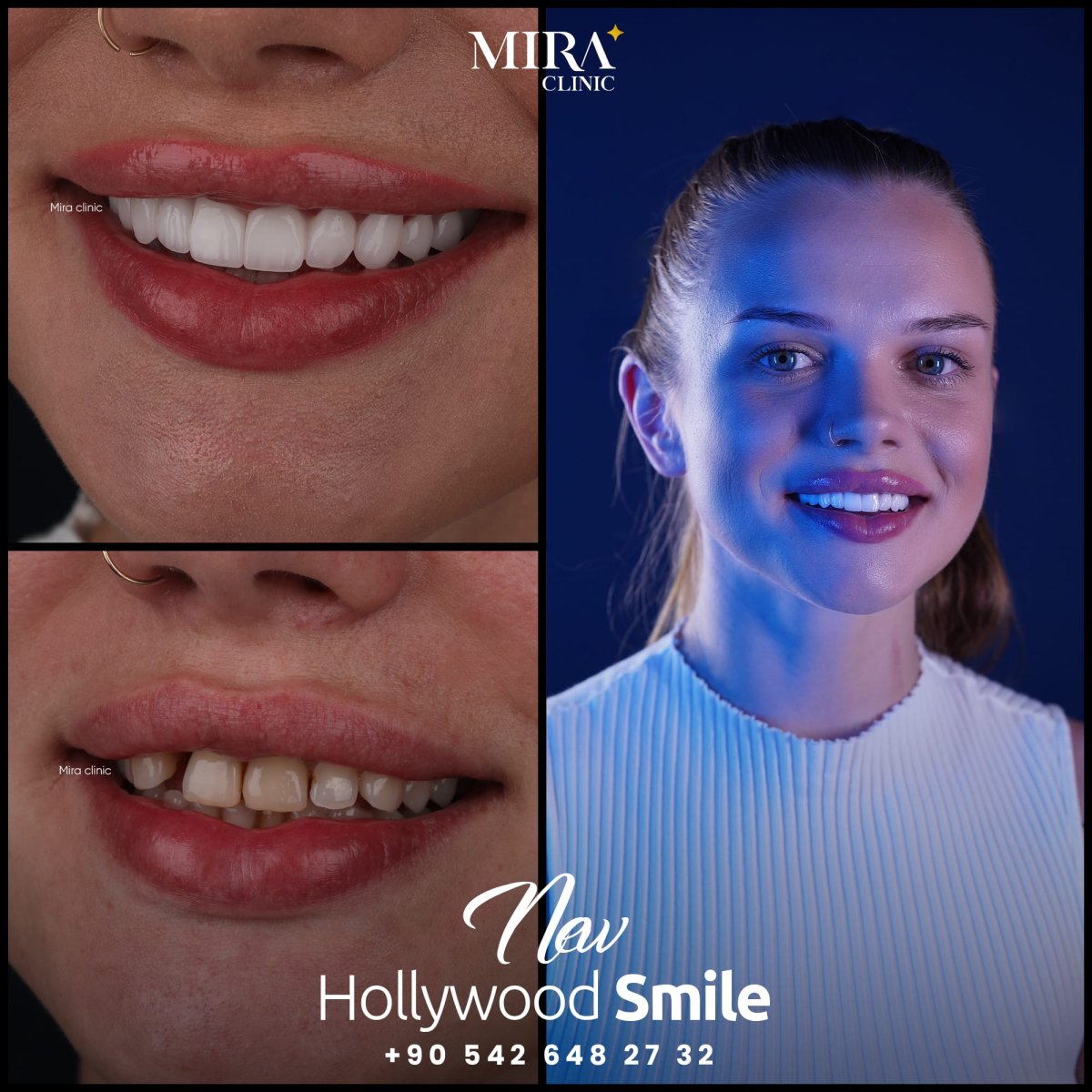 Before and after treatment at Mira Clinic Istanbul