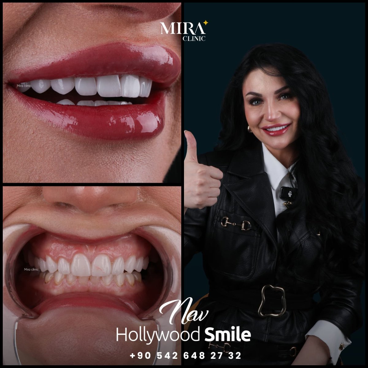 Before and after treatment at Mira Clinic Istanbul