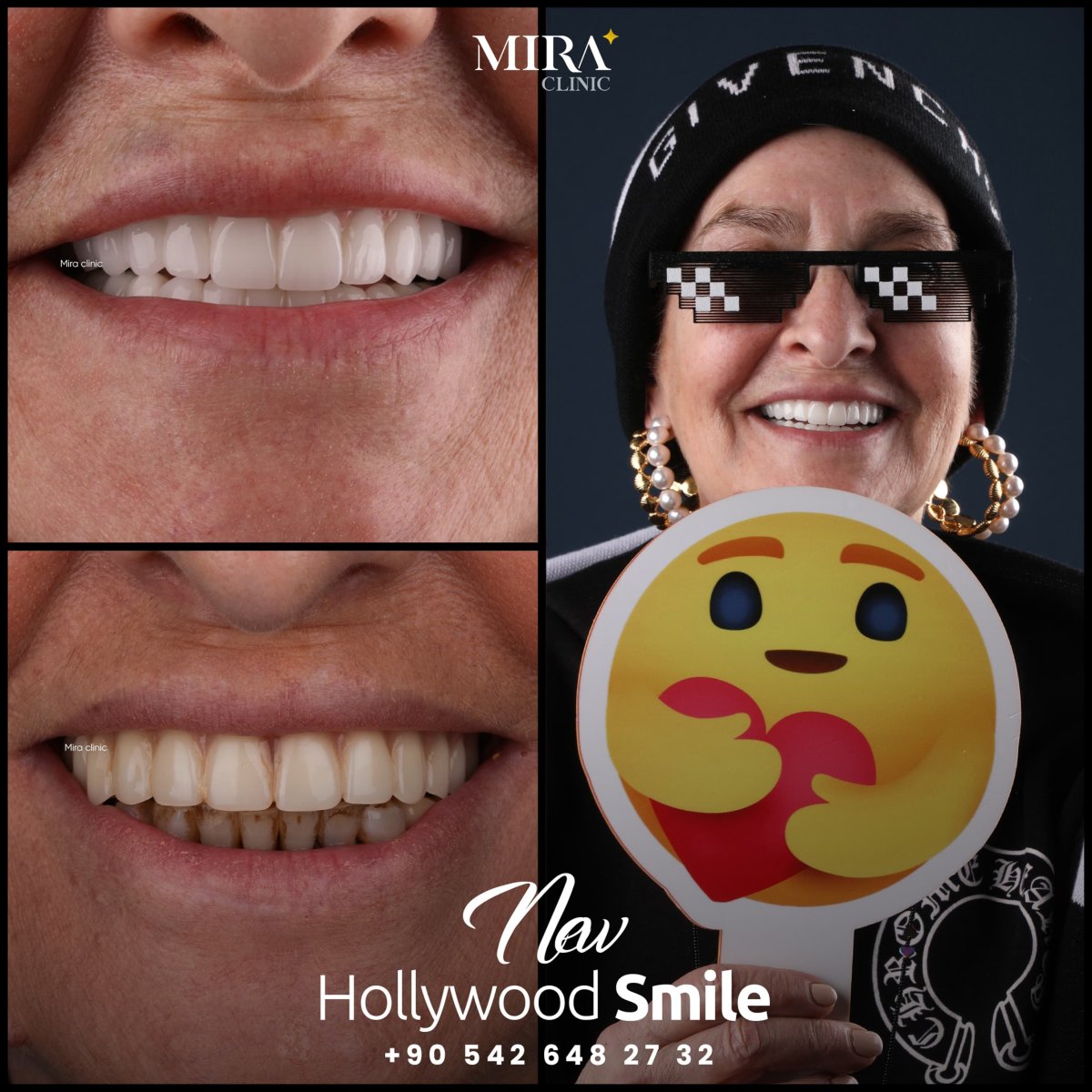 Before and after treatment at Mira Clinic Istanbul