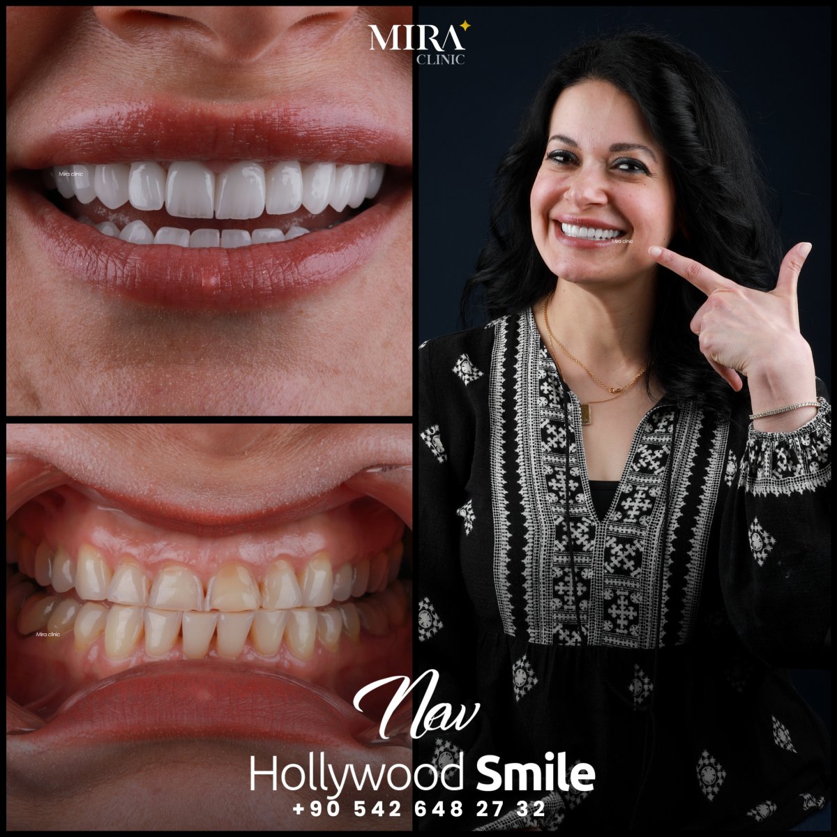 Before and after treatment at Mira Clinic Istanbul
