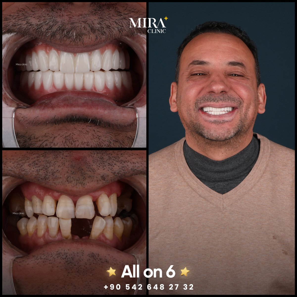 Before and after treatment at Mira Clinic Istanbul