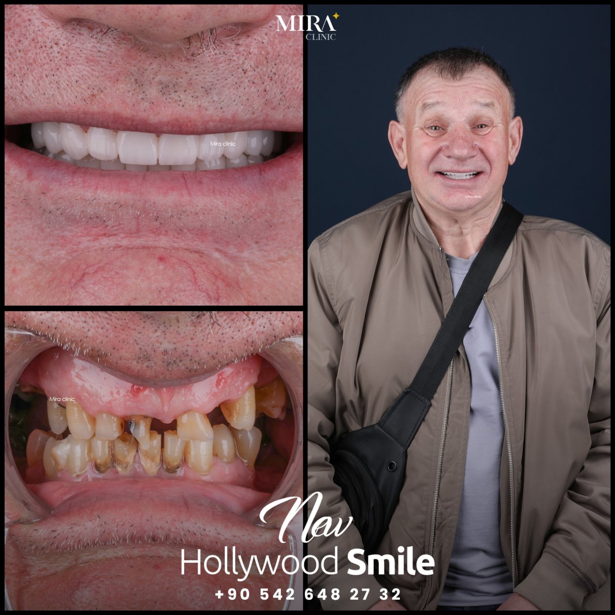 Before and after treatment at Mira Clinic Istanbul