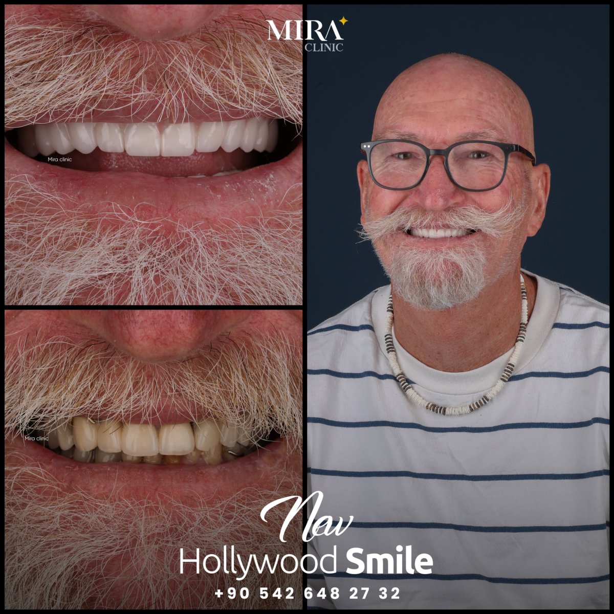Before and after treatment at Mira Clinic Istanbul