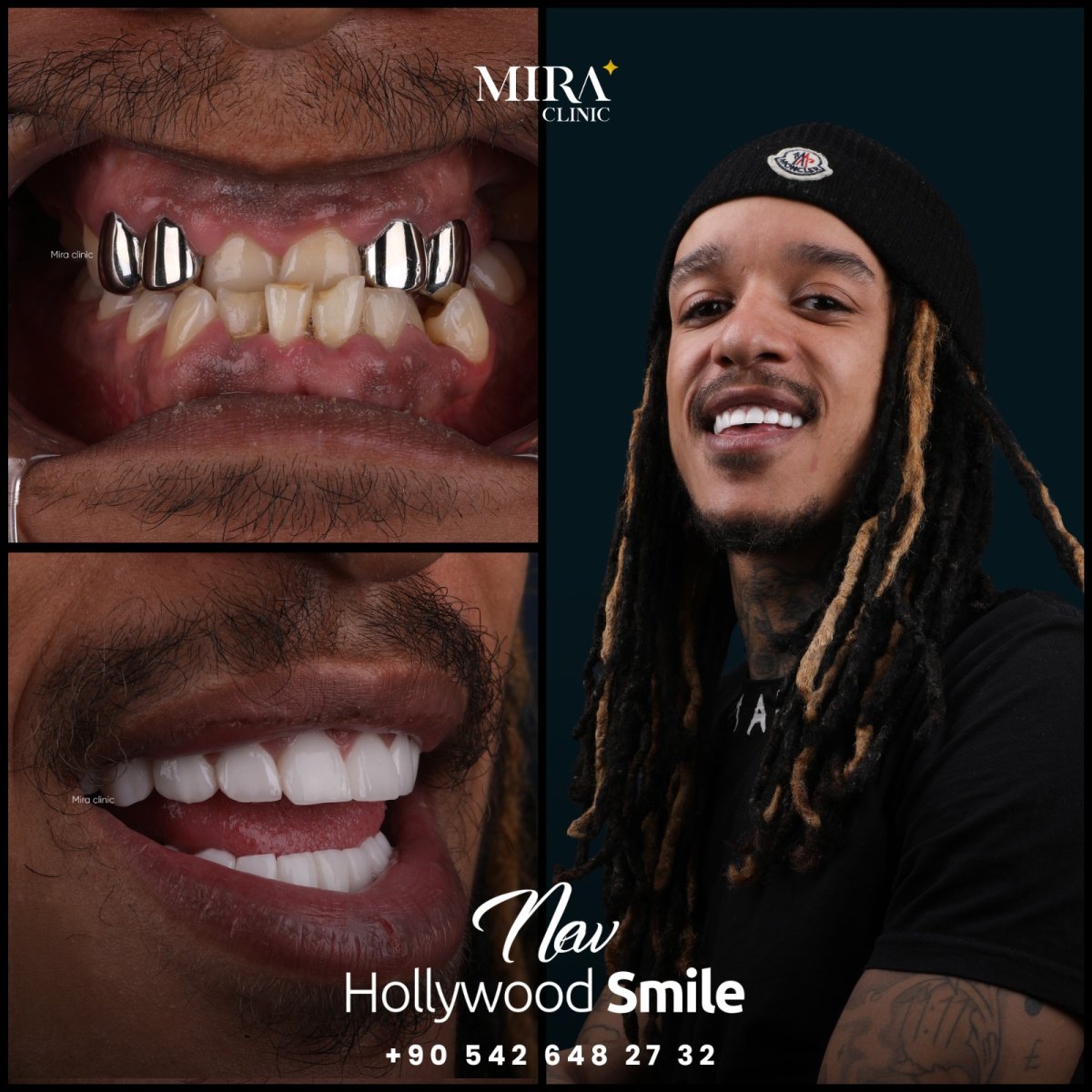 Before and after treatment at Mira Clinic Istanbul