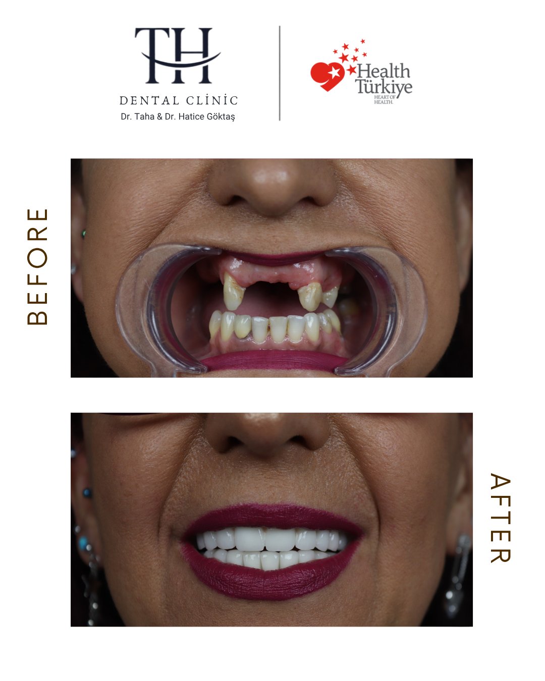 All on 6 - TH Dental Clinic