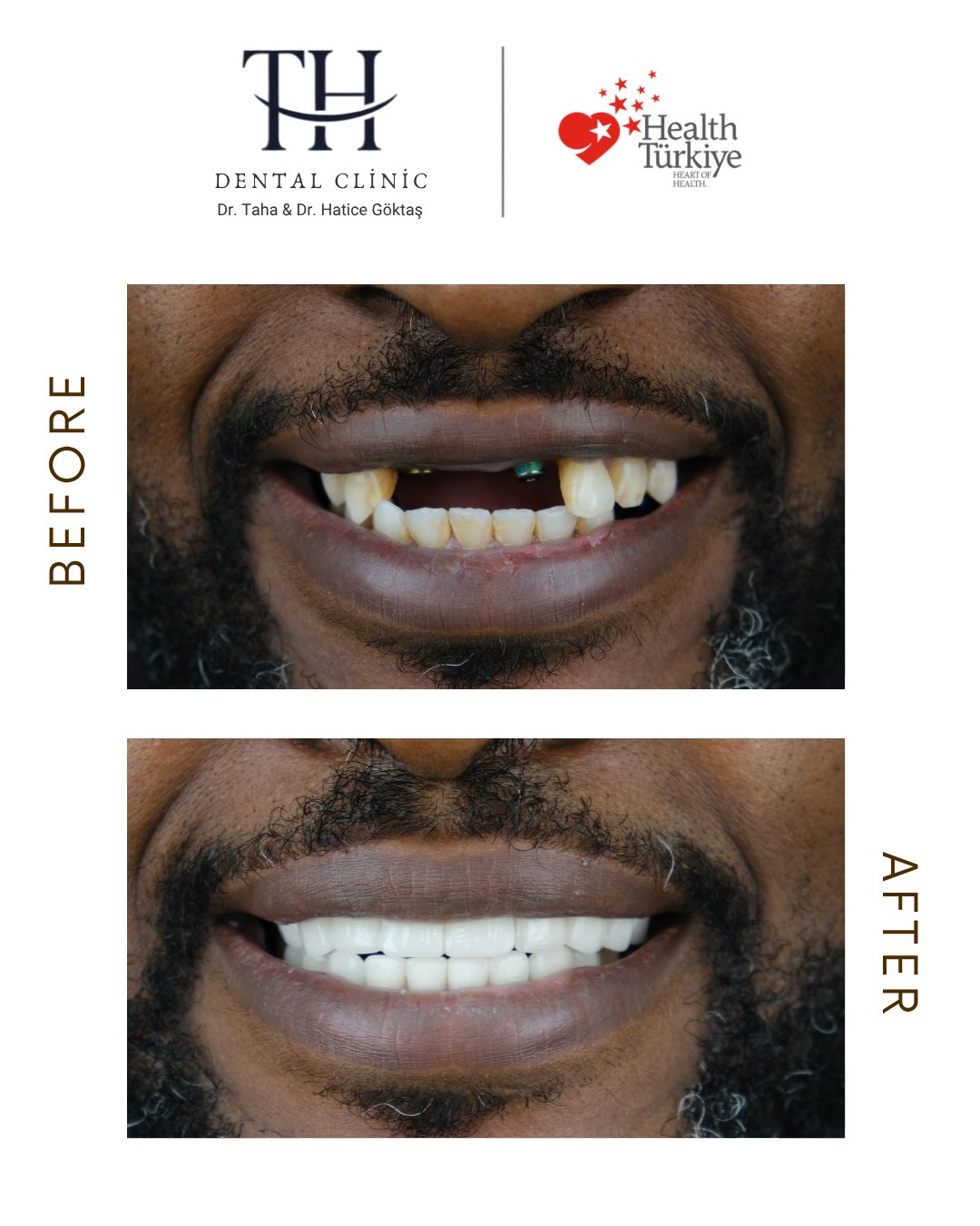 All on 4 - TH Dental Istanbul