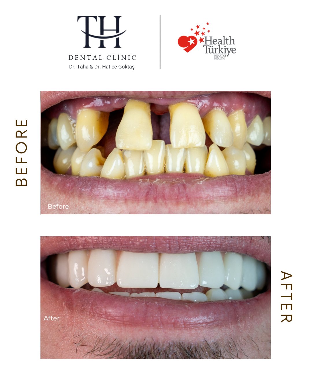 All on 6 - TH Dental Clinic