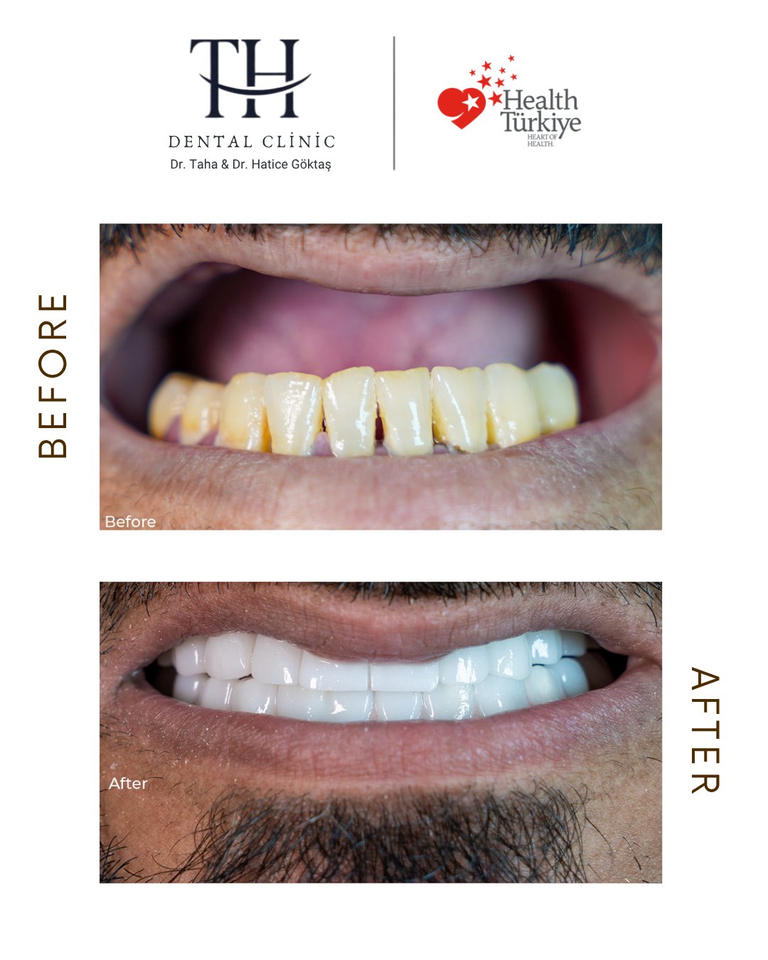 All on 6 - TH Dental Clinic