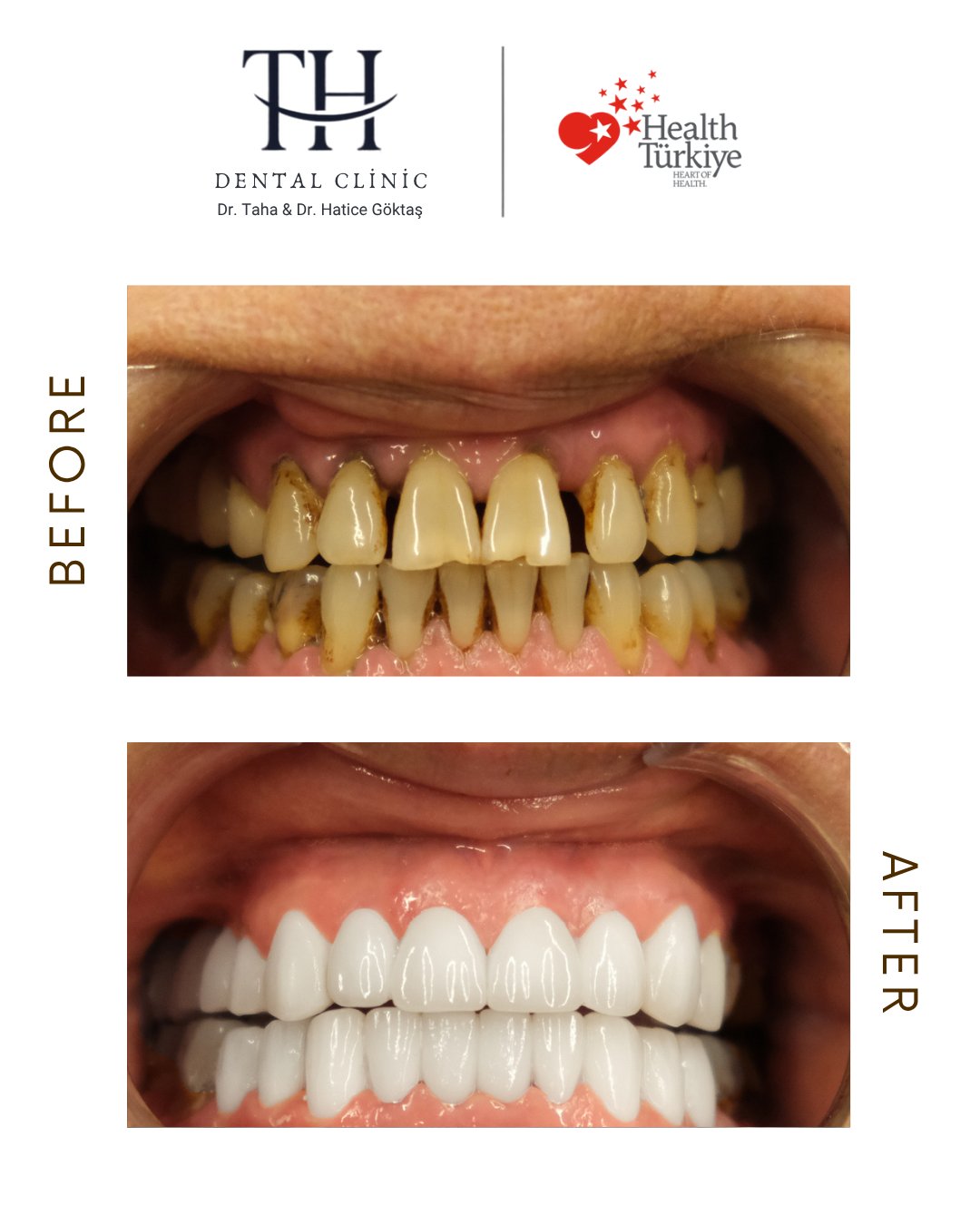 Zirconum crowns - Smile Design -TH Dental Istanbul