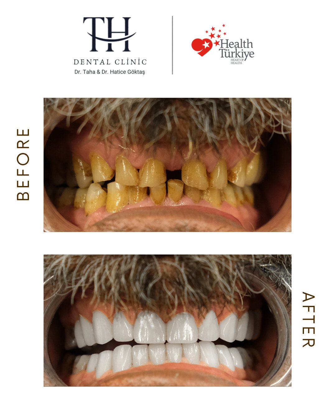 Zirconum crowns - Hollywood Smile -TH Dental Istanbul