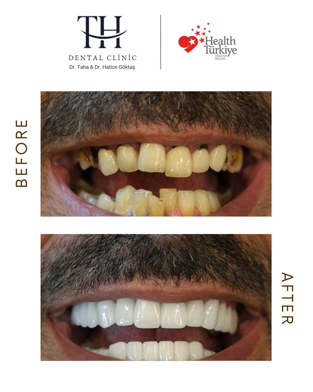 Full Mouth restoration - Dental Implant -TH Dental Istanbul
