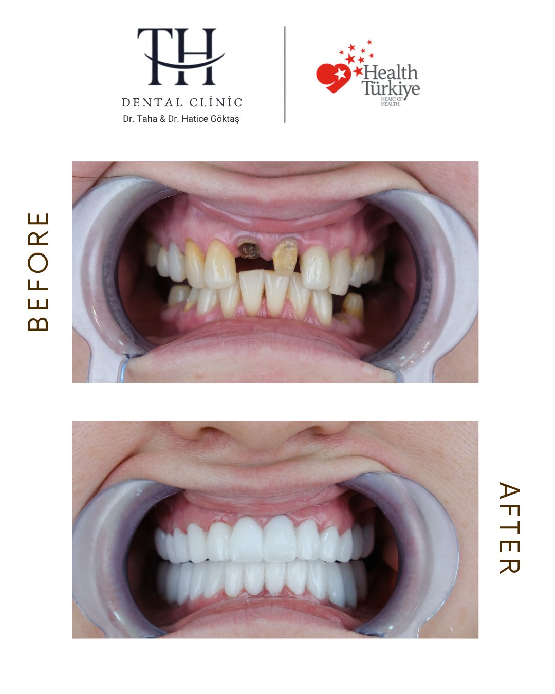 Dental Implant - TH Dental